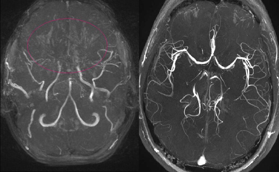 MIP MR angiogram — attenuated distal internal carotid arteries with a hazy basal collateral network (left) vs a normal study (right).